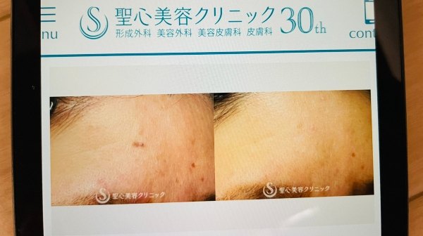 聖心美容クリニック ほくろ除去症例
