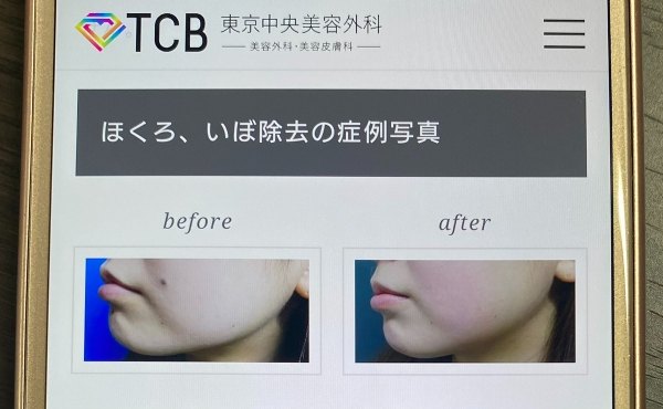 TCB東京中央美容外科 ほくろ除去症例