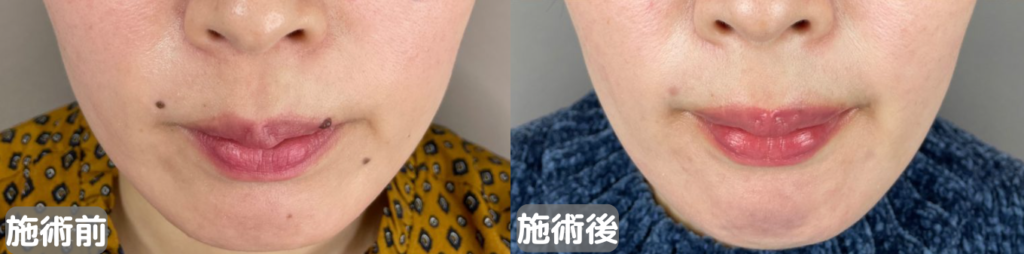 TCB東京中央美容外科 ほくろ除去症例